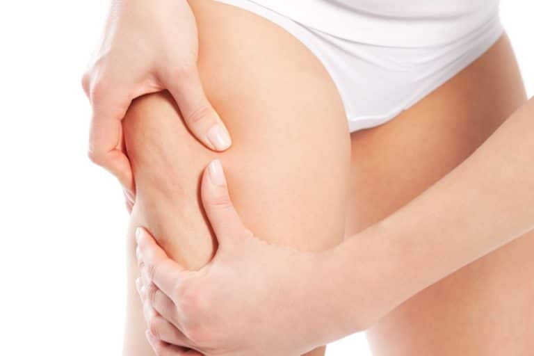 How Can I Get Rid of My Cellulite?