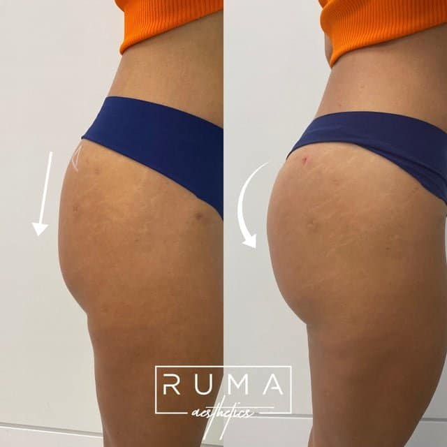 Butt lift with PDO threads – Ruma Medical Butt lift with PDO threads | Ruma Medical