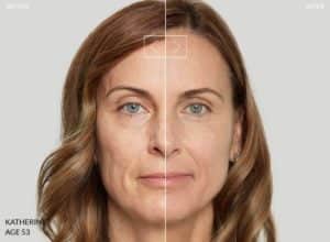 January Blog - Sculptra _One | UT-RUMA Medical January Blog - Sculptra _One | UT-RUMA Medical