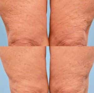 Get Sculpted with Sculptra | UT-RUMA Medical Get Sculpted with Sculptra | UT-RUMA Medical