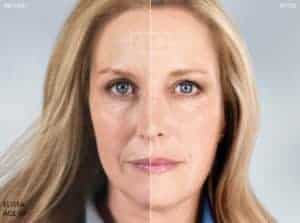 Get Sculpted with Sculptra | UT-RUMA Medical Get Sculpted with Sculptra | UT-RUMA Medical