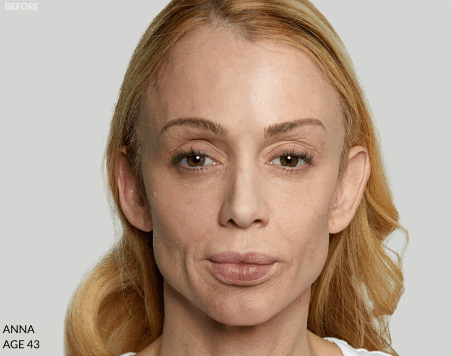 Sculptra_Two-ut-Ruma_medical Sculptra_Two-ut-Ruma_medical