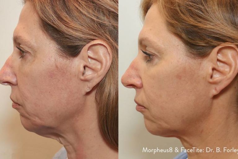 Morpheus 8 Face and Body