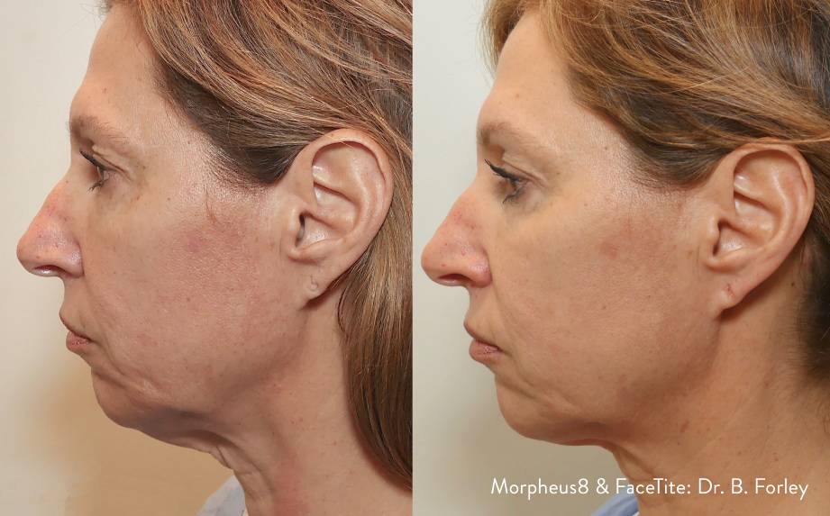 Morpheus 8 Face and Body