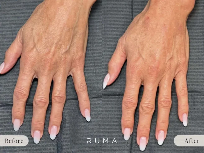 Restore Youthful Hands with Hand Filler: Benefits & What to Expect Restore Youthful Hands with Hand Filler: Benefits & What to Expect