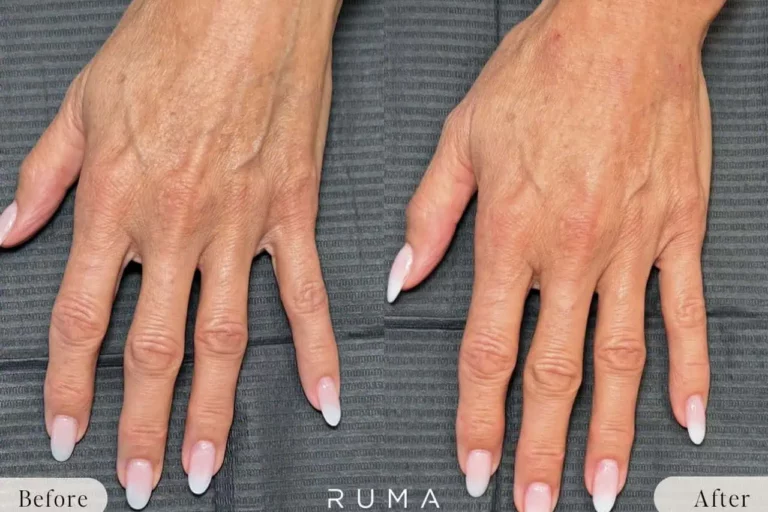 Restore Youthful Hands with Hand Filler: Benefits & What to Expect