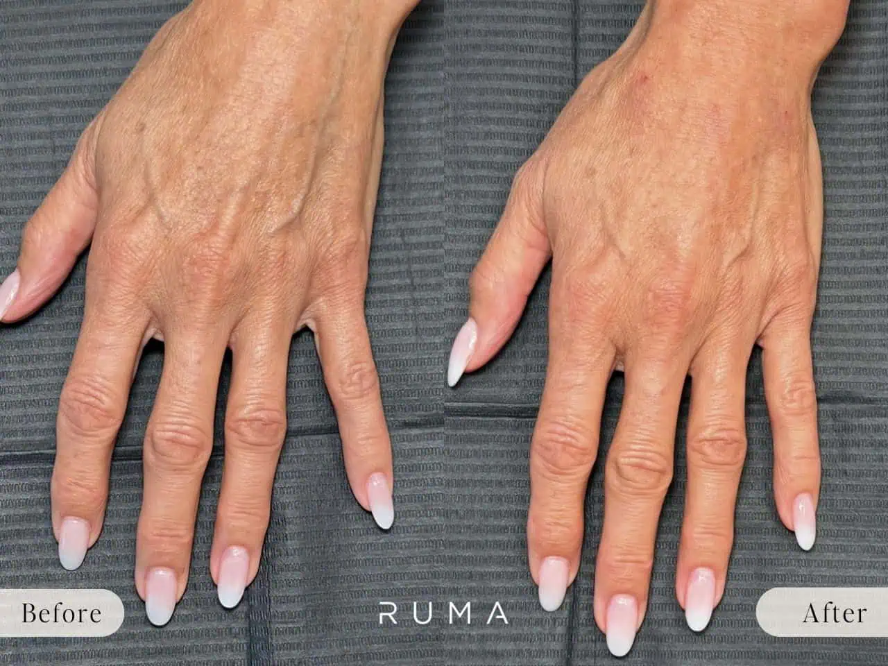 Restore Youthful Hands with Hand Filler: Benefits & What to Expect Restore Youthful Hands with Hand Filler: Benefits & What to Expect