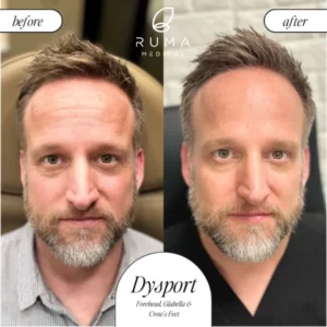Dysport Treatment Before/After At Ruma Medical Dysport Treatment Before/After At Ruma Medical
