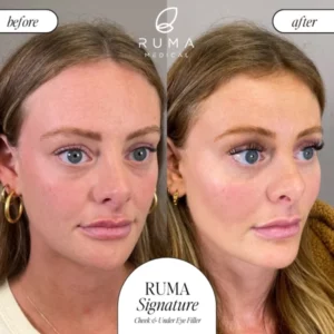 Fillers Treatment Before/After Ruma Medical Fillers Treatment Before/After Ruma Medical
