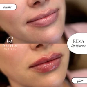 Fillers Treatment Before/After Ruma Medical Fillers Treatment Before/After Ruma Medical