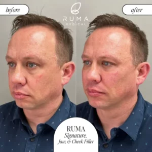 Fillers Treatment Before/After Ruma Medical Fillers Treatment Before/After Ruma Medical