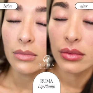 Fillers Treatment Before/After Ruma Medical Fillers Treatment Before/After Ruma Medical
