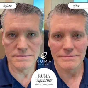 Fillers Treatment Before/After Ruma Medical Fillers Treatment Before/After Ruma Medical