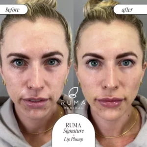 Fillers Treatment Before/After Ruma Medical Fillers Treatment Before/After Ruma Medical