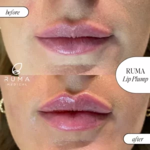 Fillers Treatment Before/After Ruma Medical Fillers Treatment Before/After Ruma Medical