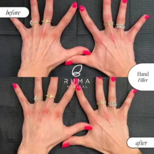 Fillers Treatment Before/After Ruma Medical Fillers Treatment Before/After Ruma Medical