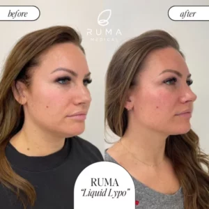 Kybella Treatment Before/After At Ruma Medical Kybella Treatment Before/After At Ruma Medical