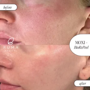 Laser Treatments Before/After At Ruma Medical Laser Treatments Before/After At Ruma Medical