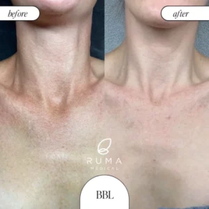 Laser Treatments Before/After At Ruma Medical Laser Treatments Before/After At Ruma Medical