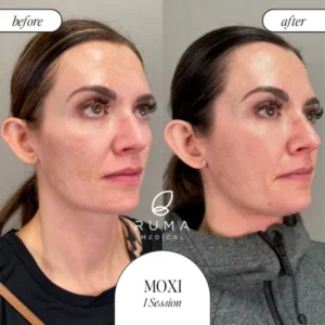 Laser Treatments Before/After At Ruma Medical Laser Treatments Before/After At Ruma Medical