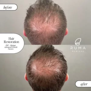 PRP/PRF Treatment Before/After At Ruma Medical PRP/PRF Treatment Before/After At Ruma Medical