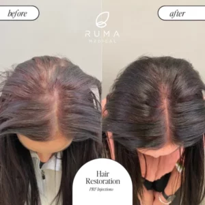 PRP/PRF Treatment Before/After At Ruma Medical PRP/PRF Treatment Before/After At Ruma Medical
