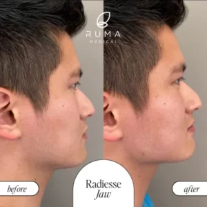 Sculptra Treatment Before/After At Ruma Medical Sculptra Treatment Before/After At Ruma Medical